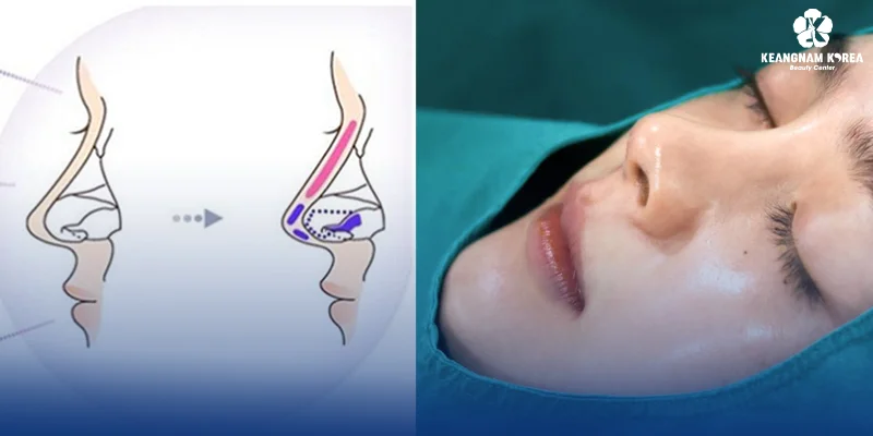 5 Natural Looking Rhinoplasty Services at Keangnam Korea 3 Super Structure Rhinoplasty