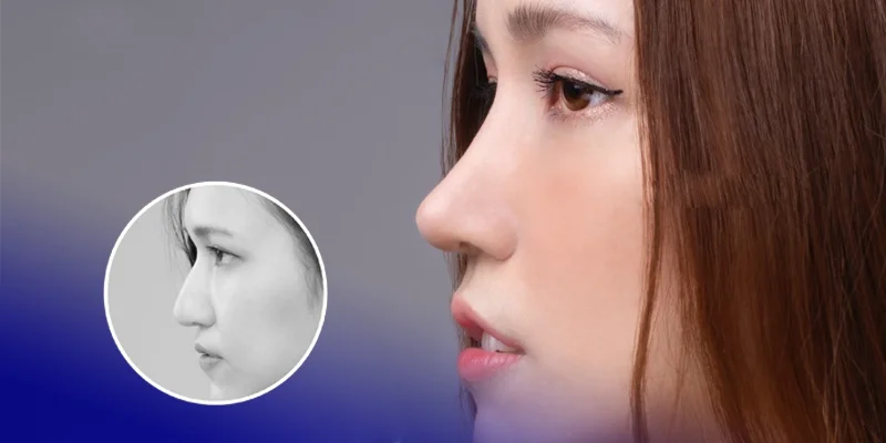 Nose Job First or Double Eyelid Surgery? What to Choose 1 Should You Get Eyelid Surgery First or a Nose Job First for a More Balanced Face?