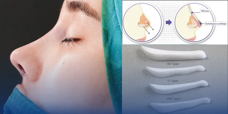 5 Natural Looking Rhinoplasty Services at Keangnam Korea 5 Natural Korean Rhinoplasty