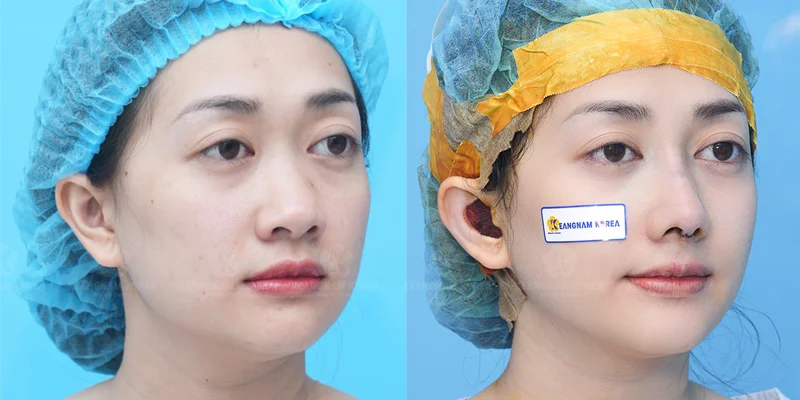 Nose Job First or Double Eyelid Surgery? What to Choose 5 Should You Get Nose Job First