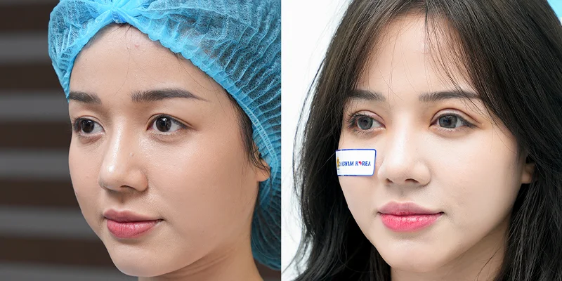 Nose Job First or Double Eyelid Surgery? What to Choose 3 Advantages of Having Double Eyelid Surgery First