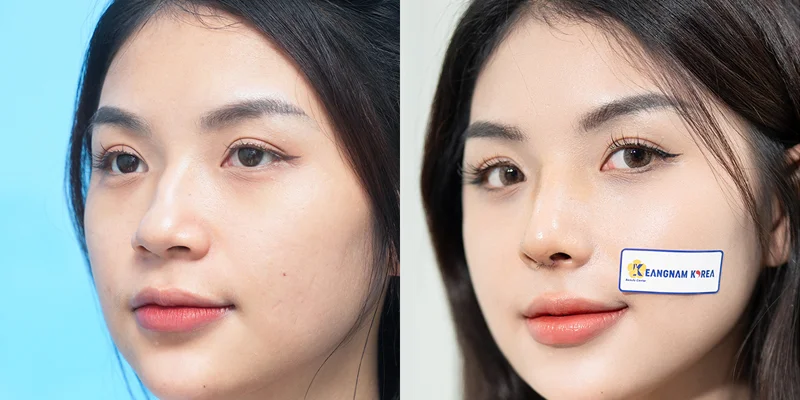 Nose Job First or Double Eyelid Surgery? What to Choose 2 Advantages of Getting a Nose Job First