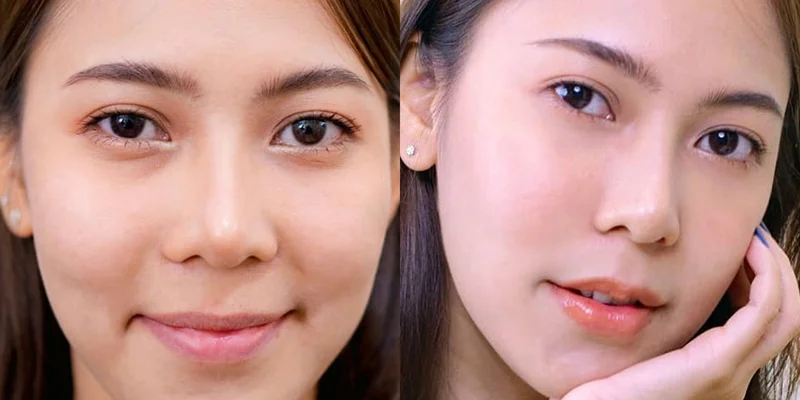 Top 5 Nasolabial Folds Treatment Methods to Effectively and Quickly Eliminate Deep Smile Lines 2 Nasolabial folds treatment using Botox or Filler injections