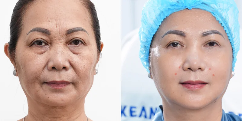 Top 5 Nasolabial Folds Treatment Methods to Effectively and Quickly Eliminate Deep Smile Lines 5 Nasolabial folds treatment using Reborn Cell Extra+ technology