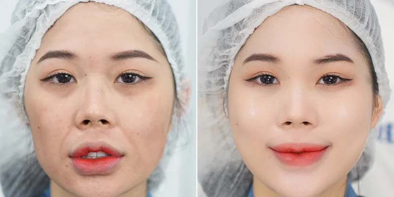 Top 5 Nasolabial Folds Treatment Methods to Effectively and Quickly Eliminate Deep Smile Lines 4 Nasolabial folds treatment with Endoscopic Facelift
