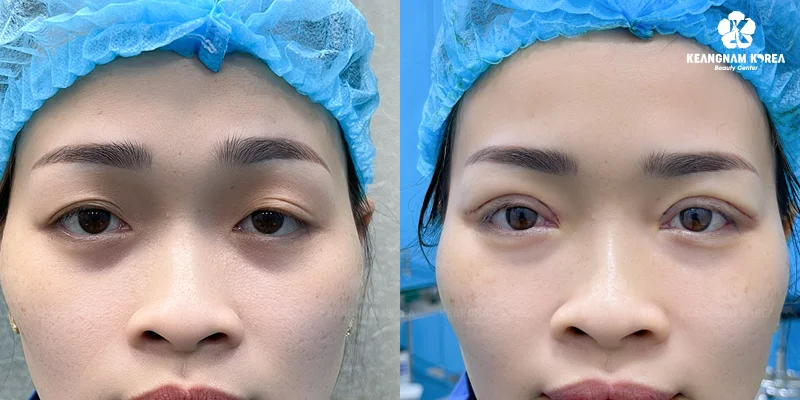 Should You Choose Eyelid Lift or Brow Lift? Which Technique Is More Beautiful and Long-Lasting? 3 Suitable candidates for eyelid lift