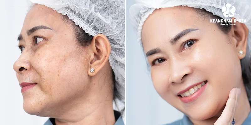 What Is Endoscopic Facelift Surgery? Is It Effective and Safe? Who Is It Suitable For? 1 What Is Endoscopic Facelift?