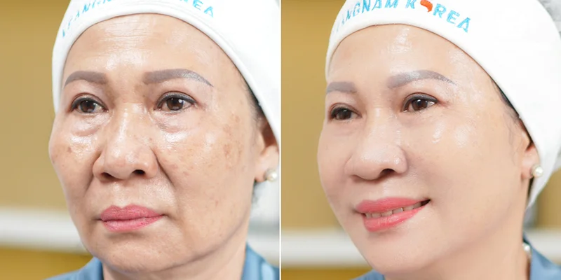 What Is Endoscopic Facelift Surgery? Is It Effective and Safe? Who Is It Suitable For? 2 Is Endoscopic Facelift Effective?