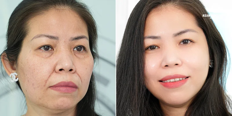 How Much Does Deep Smile Lines Treatment Cost? Updated Pricing 2026 3 Deep Smile Lines Treatment with Reborn Cell Extra+ Technology