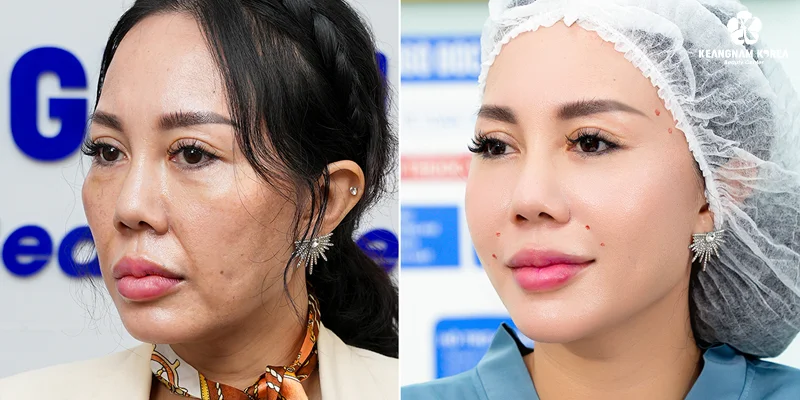 How Much Does Deep Smile Lines Treatment Cost? Updated Pricing 2026 4 Deep Smile Lines Treatment with Endoscopic Lifting