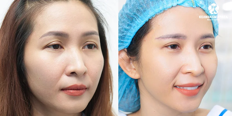 Should You Choose Eyelid Lift or Brow Lift? Which Technique Is More Beautiful and Long-Lasting? 2 Advantages and Disadvantages of Brow Lift