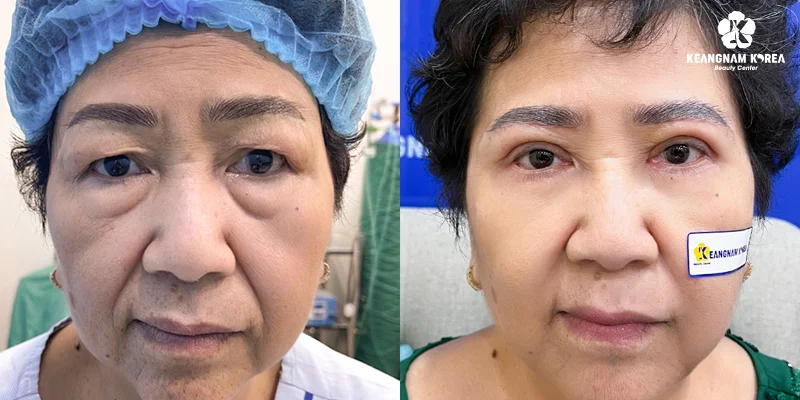 What Are the Pros and Cons of Eyebrow Lift Surgery? 4 Images of lower eyebrow lift surgery at Keangnam Korea