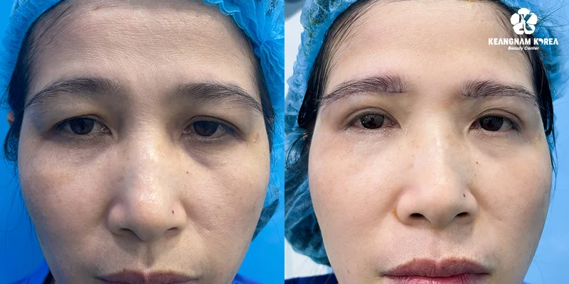 What Are the Pros and Cons of Eyebrow Lift Surgery? 3 Images of upper eyebrow lift surgery at Keangnam Korea