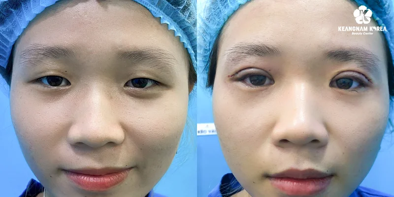 What Are the Pros and Cons of Eyebrow Lift Surgery? 5 Eyebrow Lift Surgery with Perfect Eyes
