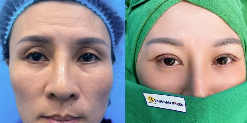 What Is Ptosis Surgery? How Much Does Ptosis Surgery Cost? 1 What Is Ptosis Surgery? How Much Does Ptosis Surgery Cost?