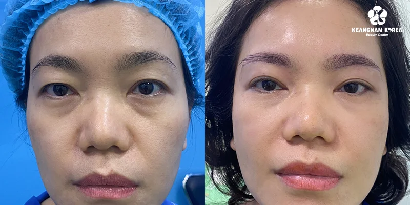 What Are the Pros and Cons of Eyebrow Lift Surgery? 2 What Is Eyebrow Lift Surgery?