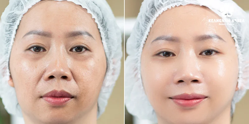 Nasolabial folds treatment: Should you choose filler injections or a facelift? 3 Advantages and disadvantages of nasolabial folds treatment using an endoscopic facelift