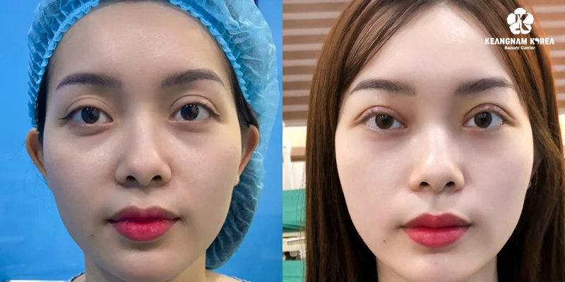 What Are the Pros and Cons of Eyebrow Lift Surgery? 6 Eyebrow Lift Surgery Methods at Keangnam Korea