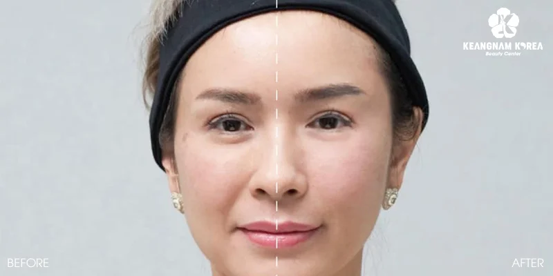 Nasolabial folds treatment: Should you choose filler injections or a facelift? 2 Advantages and disadvantages of nasolabial folds treatment using filler injections