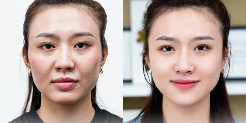 Where Is the Best Place for Smile Lines Treatment Around the Mouth? 5 Smile Lines Treatment with Reborn Cell Extra+ Technology