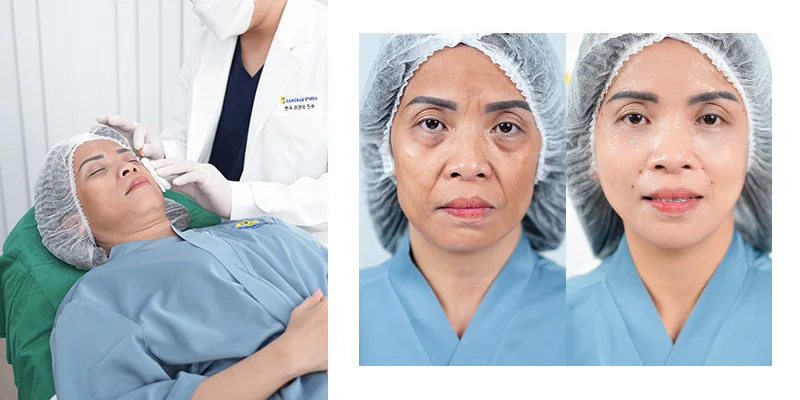 Facelift Methods: 7 Ways to Lift & Tighten Your Skin Fast 2 What Is a Non-Surgical Facelift?