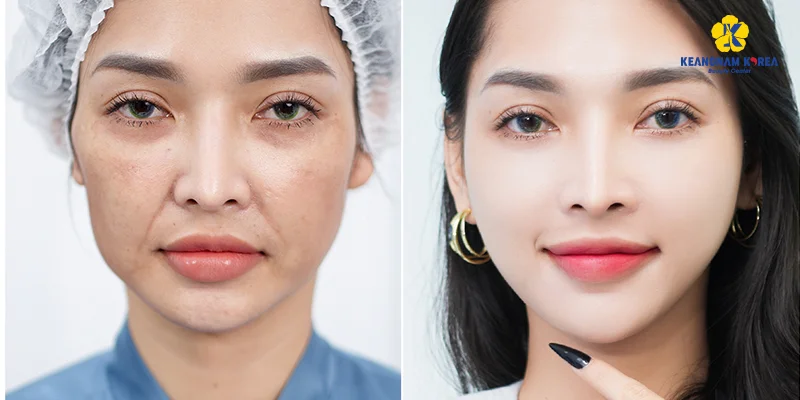 Facelift Methods: 7 Ways to Lift & Tighten Your Skin Fast 6 Endoscopic Facelift Surgery