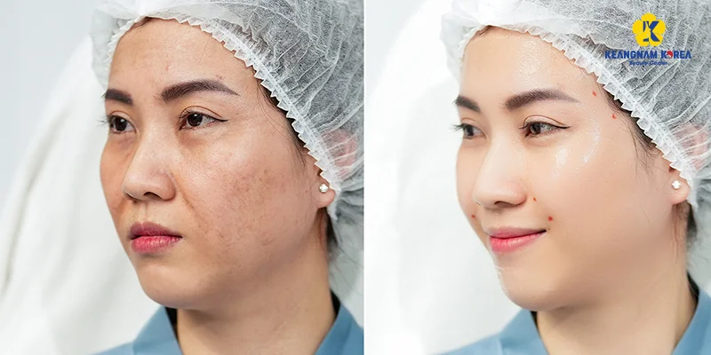 Facelift Methods: 7 Ways to Lift & Tighten Your Skin Fast 5 Facelift with Reborn Cell Extra+ Technology