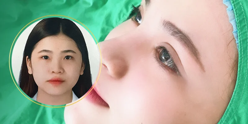 What Is Mini Incision Double Eyelid Surgery? Should You Choose It? 1 What Is Mini Incision Double Eyelid Surgery? Should You Choose It?