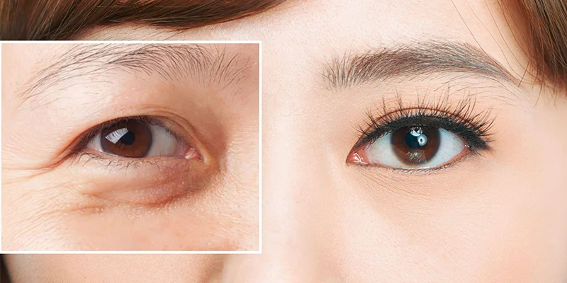 What Is Mini Incision Double Eyelid Surgery? Should You Choose It? 2 Who Should Choose Mini Incision Double Eyelid Surgery?