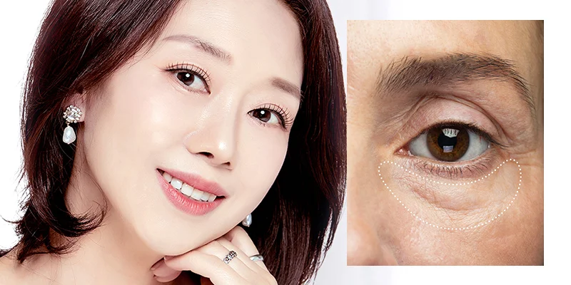 Under Eye Fat Grafting: Benefits, Who It’s For & Where Is the Best Place? 1 Under Eye Fat Grafting: Benefits, Cost & Natural Results