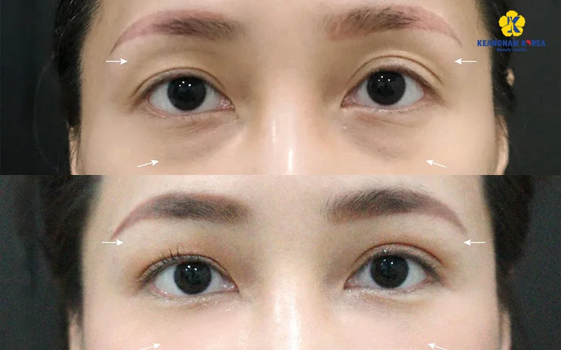 Under Eye Fat Grafting: Benefits, Who It’s For & Where Is the Best Place? 5 Lower Eyelid Fat Grafting