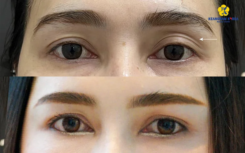 Under Eye Fat Grafting: Benefits, Who It’s For & Where Is the Best Place? 4 Upper Eyelid Fat Grafting