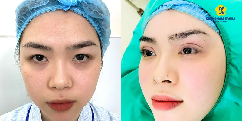 What Is Mini Incision Double Eyelid Surgery? Should You Choose It? 4 Is Mini Incision Double Eyelid Surgery Worth It?