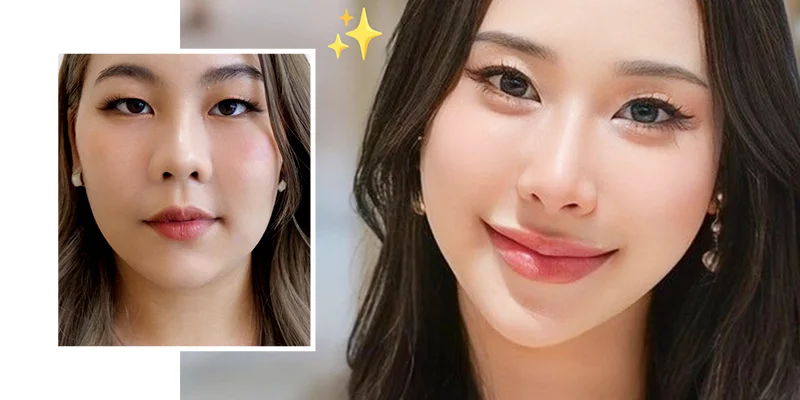 Should You Choose Facelift Surgery? What Is the Best Option in 2026? 1 Should You Choose Facelift Surgery?