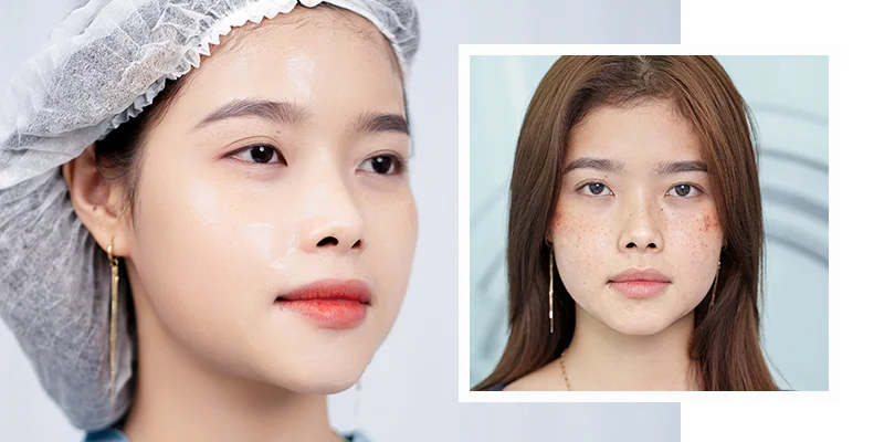 Dark Spots Treatment: Is Keangnam Korea Effective? 2 EXO PCELL+ Dark Spots Treatment at Keangnam Korea