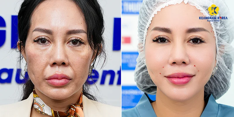 Dark Spots Treatment: Is Keangnam Korea Effective? 4 Dark Spots Treatment with Reborn Cell Extra+ at Keangnam Korea