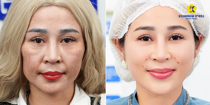 Dark Spots Treatment: Is Keangnam Korea Effective? 3 Dark Spots Treatment with Reborn Cell Extra+ at Keangnam Korea