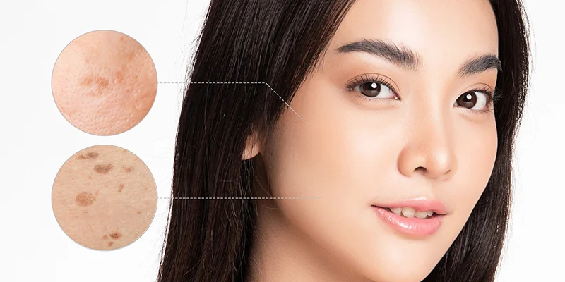Dark Spots Treatment: Is Keangnam Korea Effective? 1 Don’t let dark spots make your bright, smooth skin fade