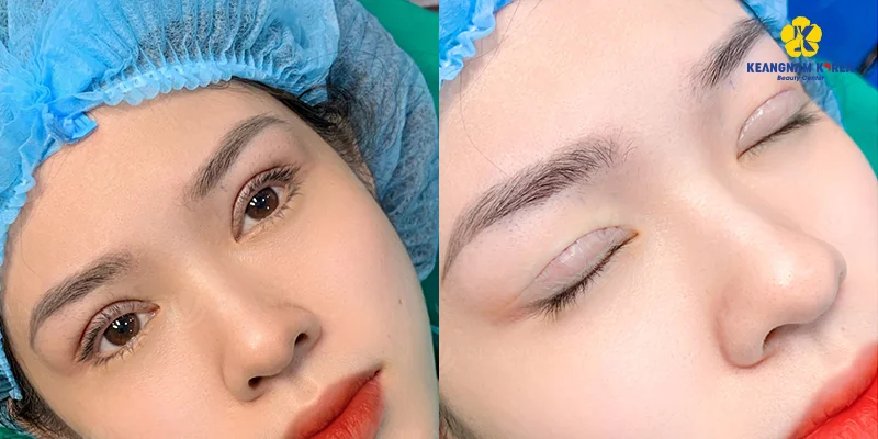 What Is Mini Incision Double Eyelid Surgery? Should You Choose It? 3 Is Mini Incision Double Eyelid Surgery Permanent?