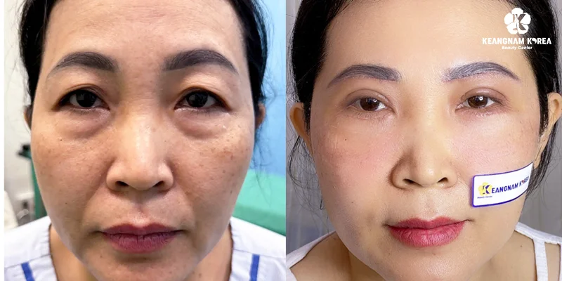 Eyebrow Lift or Eyelid Surgery? Best Choice for Younger Eyes 2 Dark Circles