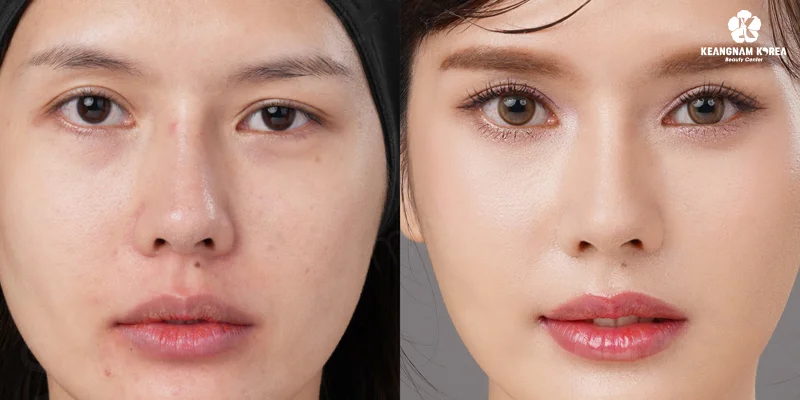 Eyebrow Lift or Eyelid Surgery? Best Choice for Younger Eyes 3 Eye Bags and Droopy Eyelids