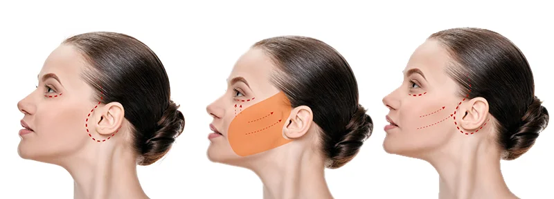 Should You Choose Facelift Surgery? What Is the Best Option in 2026? 2 What Is Facelift Surgery