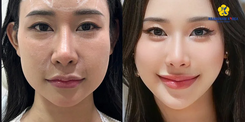 Facelift Methods: 7 Ways to Lift & Tighten Your Skin Fast 7 Mini Facelift Surgery