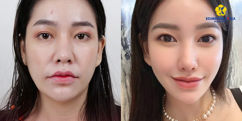 Should You Choose Facelift Surgery? What Is the Best Option in 2026? 5 Endoscopic Facelift Surgery