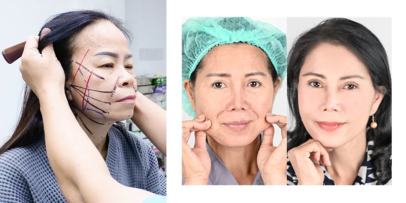 Facelift Methods: 7 Ways to Lift & Tighten Your Skin Fast 3 What Is Surgical Facelift?