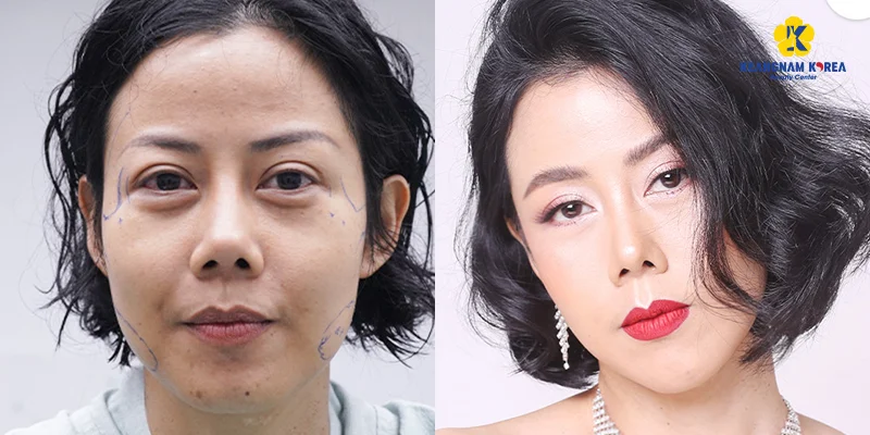 Should You Choose Facelift Surgery? What Is the Best Option in 2026? 4 Mini Facelift Surgery