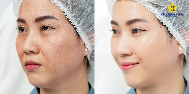 Comparison of 2 Melasma Treatment Methods at Keangnam Korea 5 Reborn Cell Extra+ is a melasma treatment