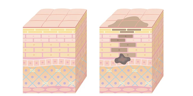 Comparison of 2 Melasma Treatment Methods at Keangnam Korea 2 Illustration of the melasma treatment mechanism using EXO PCELL+.