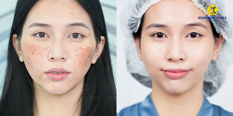 Comparison of 2 Melasma Treatment Methods at Keangnam Korea 4 melasma treatment with EXO PCELL+