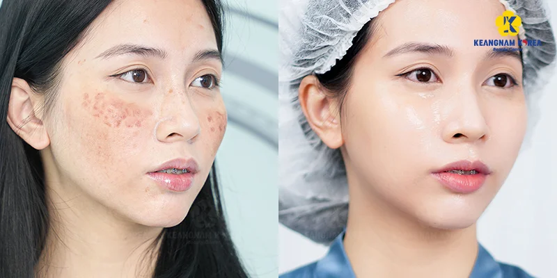 Comparison of 2 Melasma Treatment Methods at Keangnam Korea 6 EXO PCELL+ – The most advanced melasma treatment technology